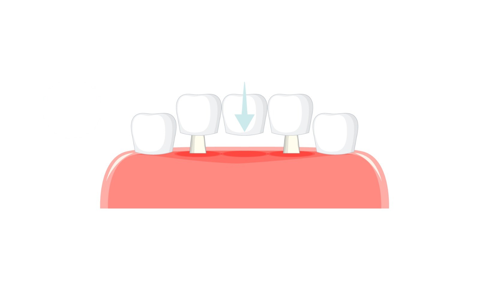 Diş Köprüsü Dental Bridge - Dt. Halime Savcı, Mardin