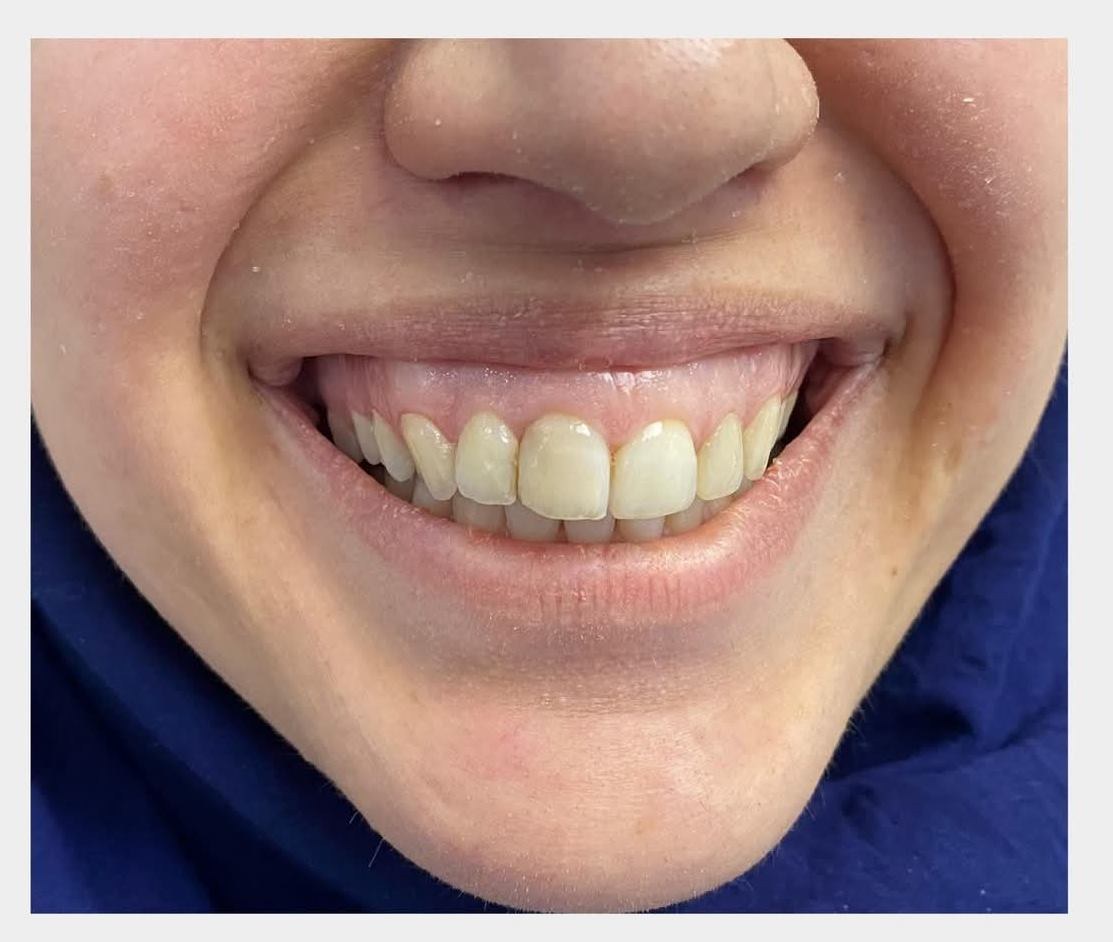 Gummy Smile Tedavisi Öncesi - Dt. Halime Savcı, Mardin