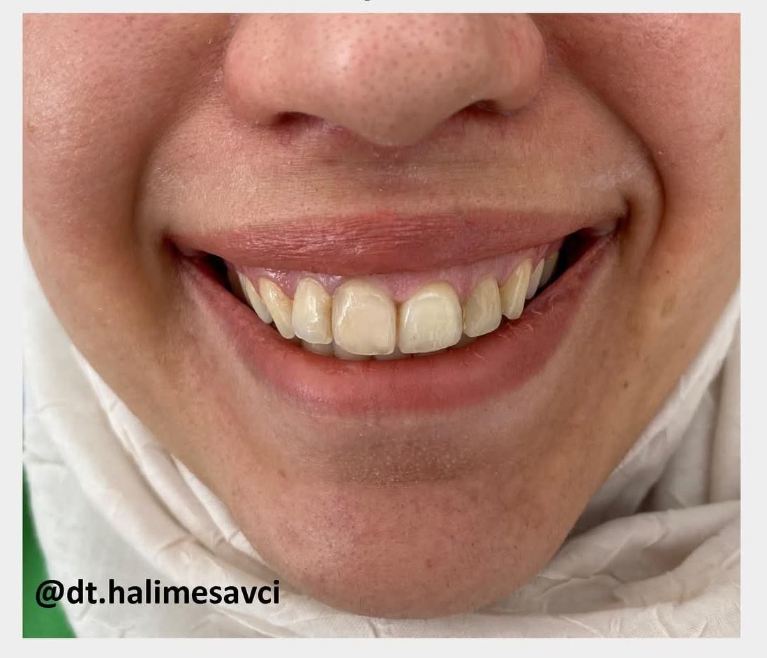Gummy Smile Tedavisi Sonrası - Dt. Halime Savcı, Mardin